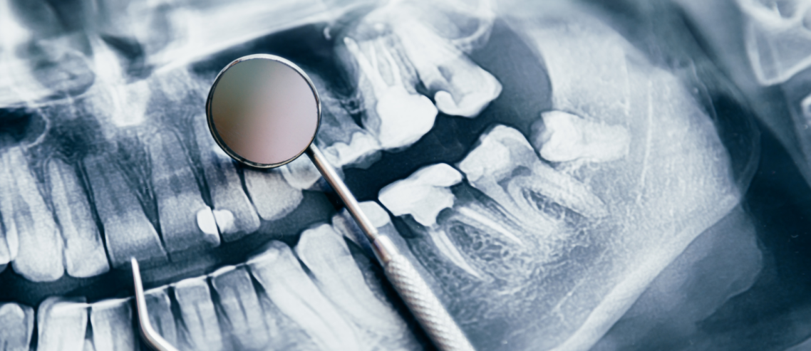 Dental X-ray image showing the teeth and jawbone.